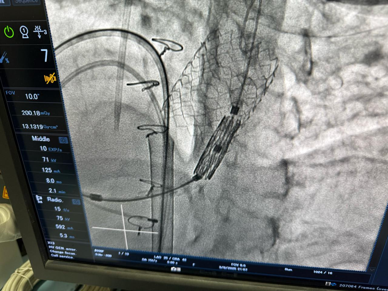 عملية تغيير الصمام الرئوي
