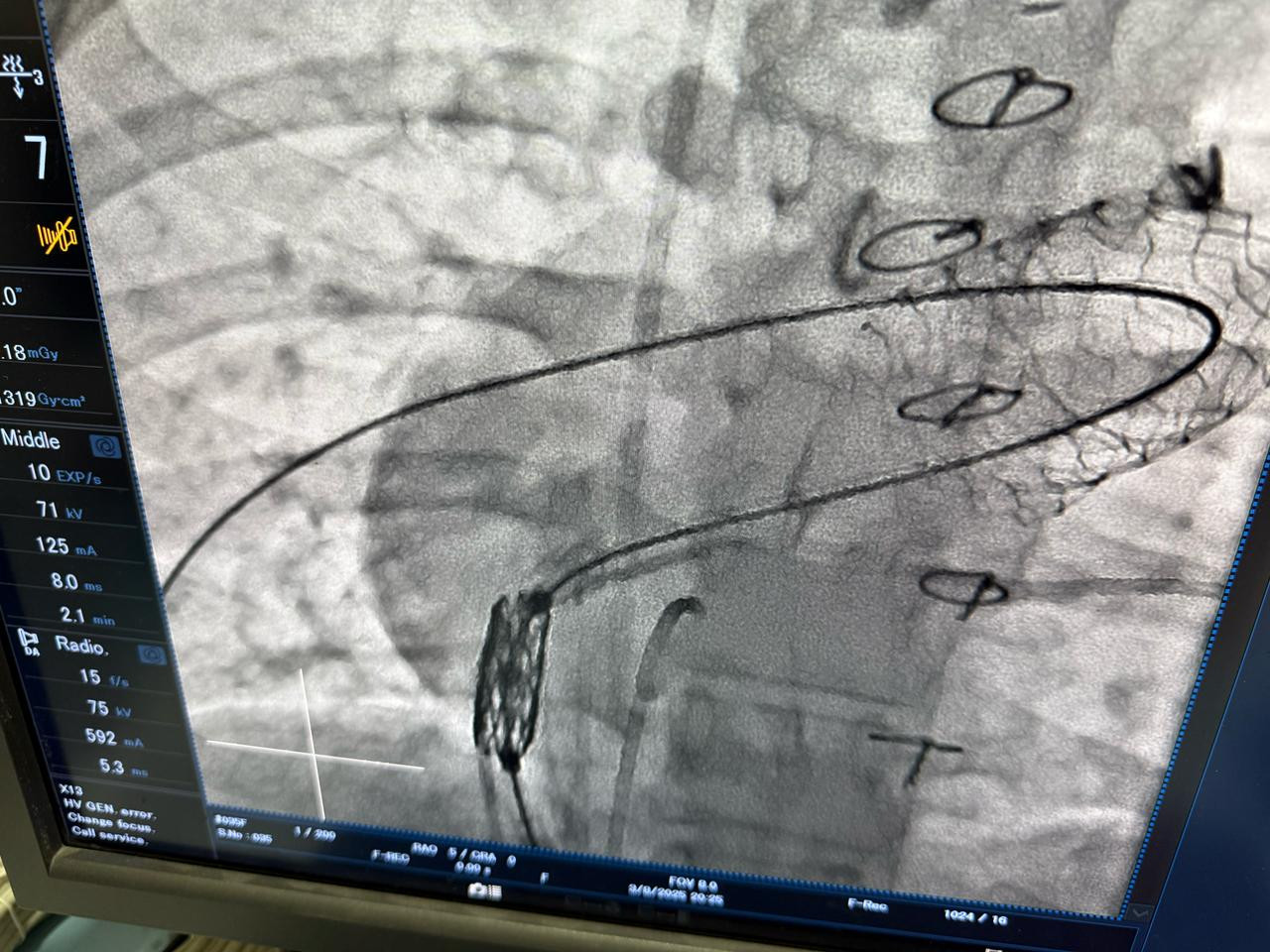 عملية تغيير الصمام الرئوي
