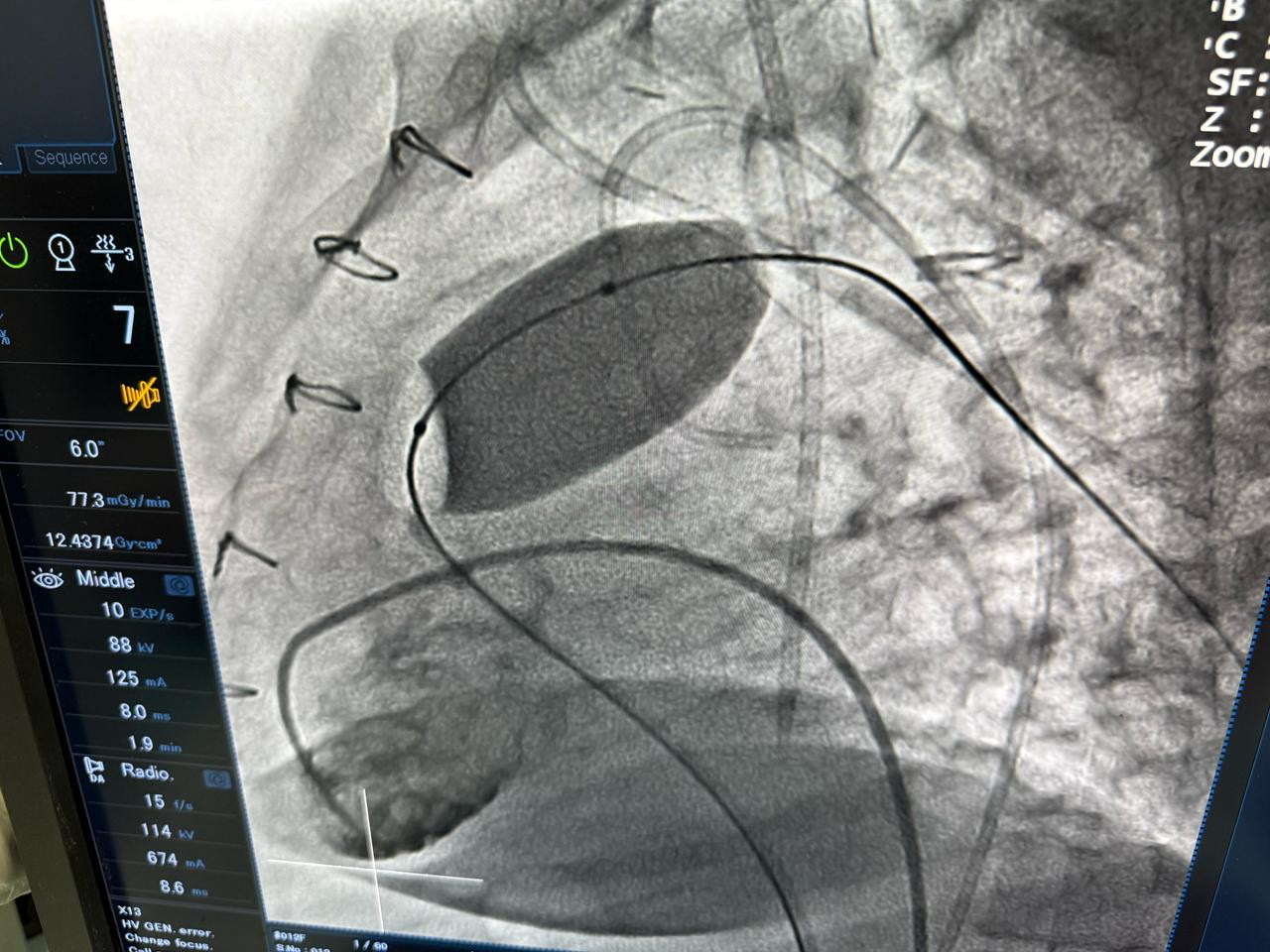 عملية تغيير الصمام الرئوي