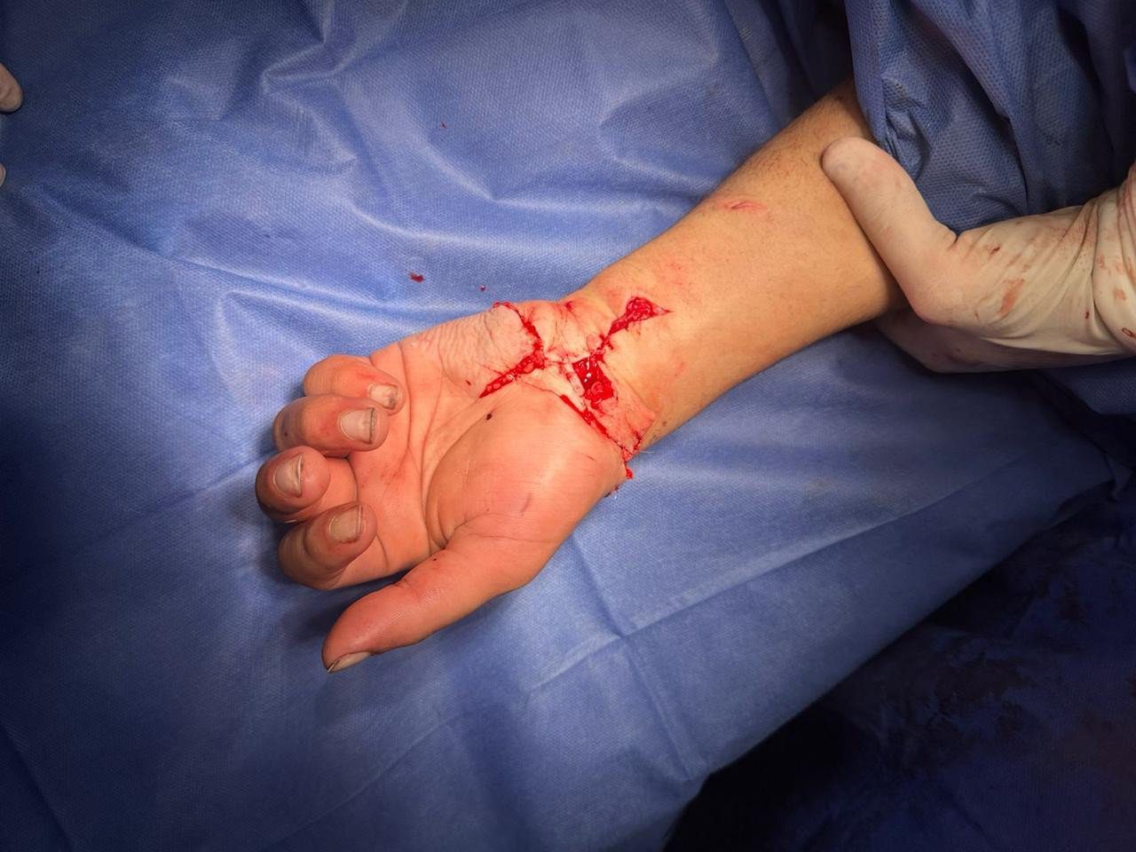 زراعة يد مبتورة