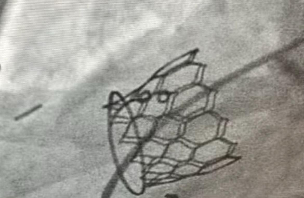 زراعة صمام رئوي