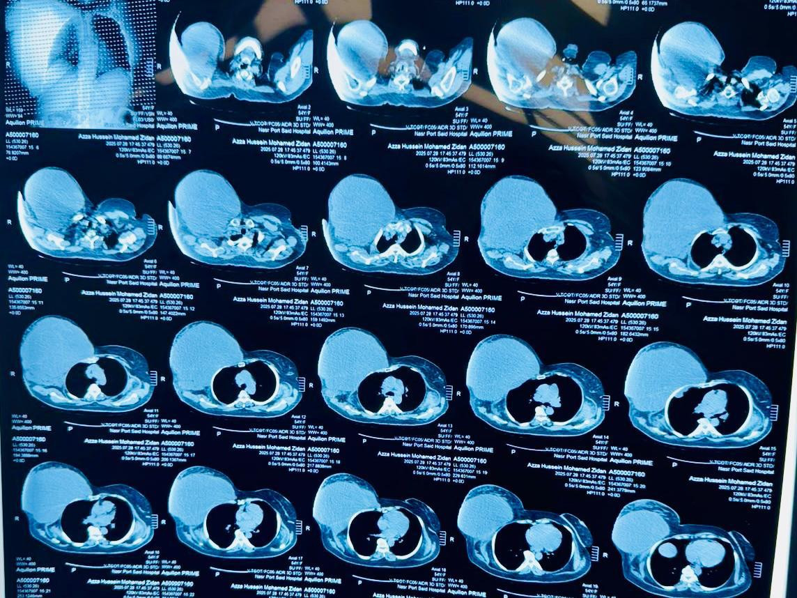 استئصال ورم