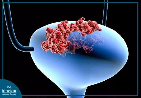 علاج مناعي جديد يفتح آفاق الأمل لمرضى سرطان المثانة