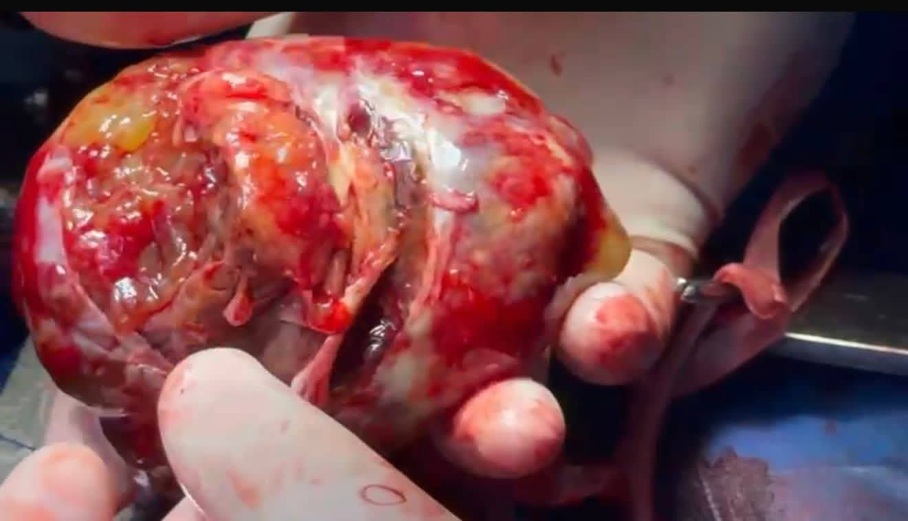 استئصال ورم